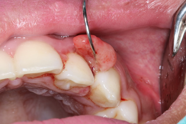 Oral Kavite Kanseri